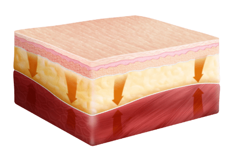 Cross-section showing negative pressure therapy creating tissue apposition