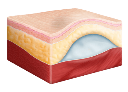 Cross-section showing seroma fluid accumulation between tissue layers