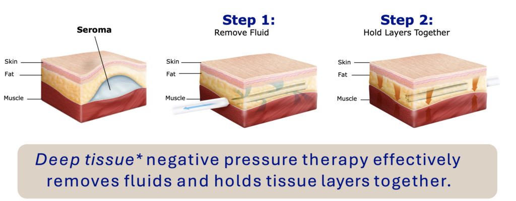 Deep tissue negative pressure therapy: Step 1 removes fluid, Step 2 holds tissue layers together