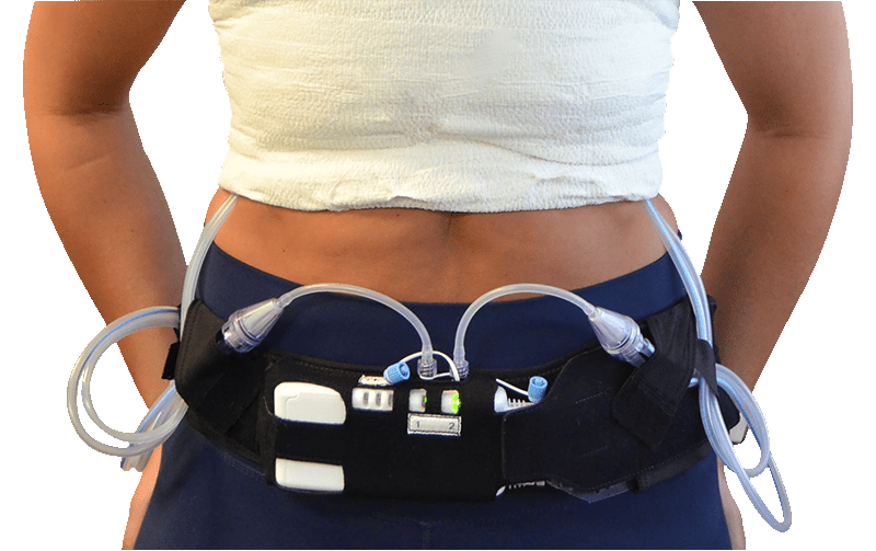 Patient wearing the SOMAVAC&reg; pump on the support belt, with both drains connected